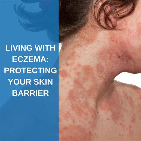 Living With Eczema Protecting Your Skin Barrier Savannah River