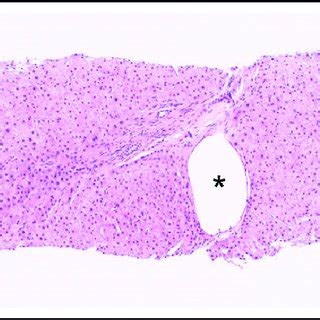 Nodular Regenerative Hyperplasia Pattern By Reticulin Stain Which