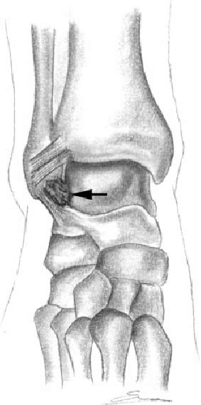 Illustration Of The Characteristic Site Of Soft Tissue Impingement