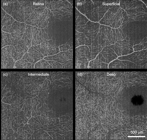 A Human Retinal Capillaries At Macula By Vis Octa B D The Download Scientific Diagram