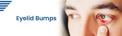 Eyelid Bumps Eyelid Lesions Symptoms Causes Treatments