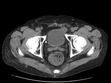 Urinary Bladder Hernia Radiology Reference Article Radiopaedia Org