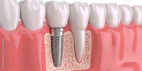 3D Render Of A Dental Implant In Jaw White Background With Copy Space