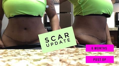 Mini Tummy Tuck Scar Before And After Photos Madedon