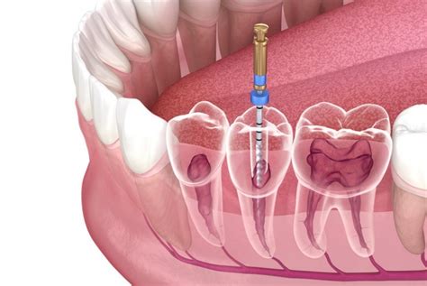 Root Canal Cost Identity Dentistry Canberra City