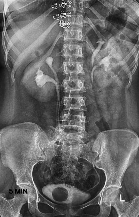 [figure Intravenous Pyelogram Shows Bilateral Duplex ] Statpearls