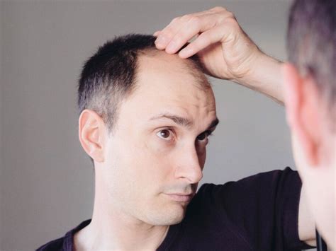 Topical application of cannabinoids shows promise for hair loss ...