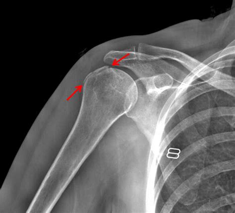 Humerus Greater Tuberosity Fracture