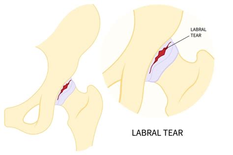 Hip Labrum Repair and Reconstruction | Rockwall, TX | Manoj Reddy