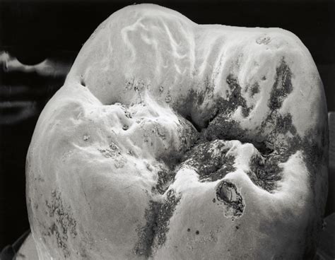 Decay On Molar Tooth, Sem Photograph by David Mccarthy - Fine Art America