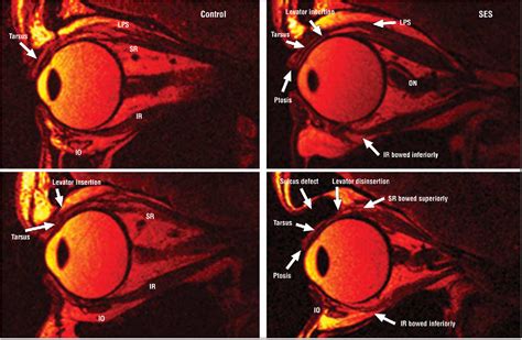 Inferior rectus muscle structure | Semantic Scholar