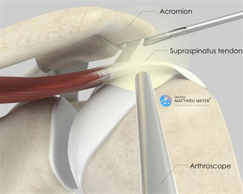 Arthroscopic Shoulder Acromioplasty Doctor Matthieu Meyer