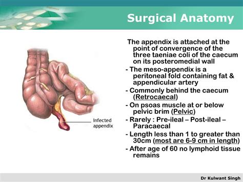 Ppt Appendicitis Powerpoint Presentation Free Download Id1703196