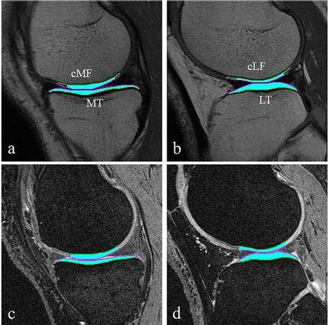 Cartilage Volume Thickness And Subchondral Bone Area Measures