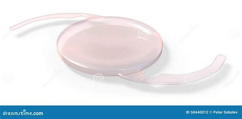 Intraocular lens implant stock illustration. Illustration of health - 50440012