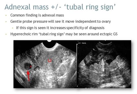 Ectopic Pregnancy Flashcards Quizlet