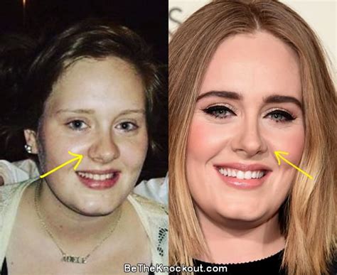 Adele Before And After Nose Job