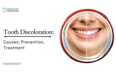 Tooth Discoloration Causes Prevention Treatment