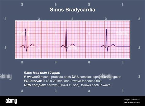 Illustration Of An Electrocardiogram Ecg Showing Sinus Bradycardia