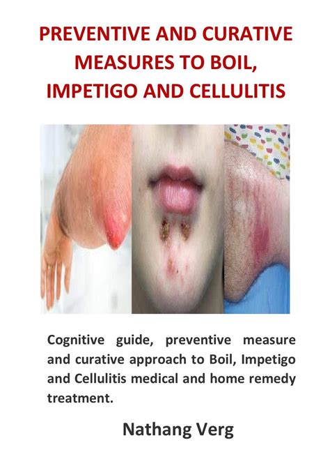 Buy Preventive and Curative Measures to Boil, Impetigo and Cellulitis ...