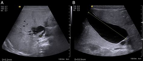 Intrahepatic Bile Duct Dilation And Gallbladder Hydrops Due To A Cystic