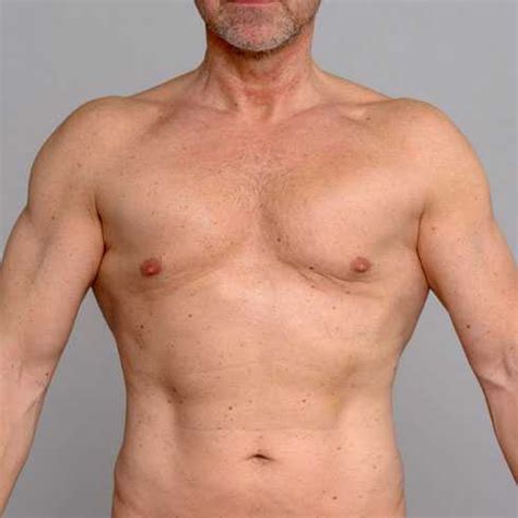 Skin Before And After Weight Loss Pictures Men