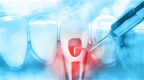 Endodontics with Laser Assisted Dentistry | Functional Aesthetic ...