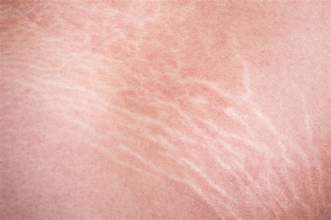 Stretch Marks — Causes Treatment And Prevention Renita Rajan Medium