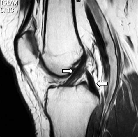 Acl Tear no longer seen On Mri