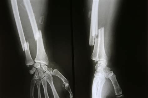 Arm Fracture : Facts, types, causes, symptoms, treatment, & care | FactDr