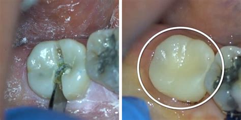 Revealing photos show how a dentist treats a cavity, from slicing and drilling to building the ...