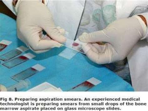 Bone marrow aspirate&biopsy preparation