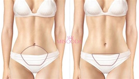 Why Korean Abdominoplasty Mini Tummy Tuck Surgery Guide Reviews