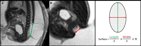 MRI evaluation of the size of the lesion. (A) Sagittal view of a ...