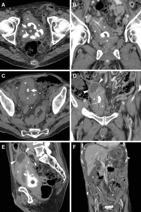 Cross Sectional Imaging Of Complicated Urinary Infections Affecting The