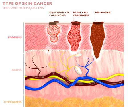 Carcinoma Basocellulare Come Si Presenta Il Basalioma E Perch Si