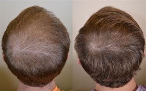 Finasteride Results Timeline Photos Before And After