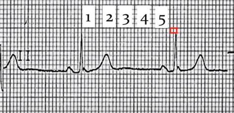 Cómo Calcular La Frecuencia Cardíaca Cerebromedico