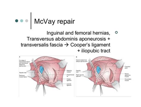 Inguinal Hernia Types