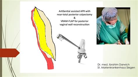 Abdominoperineal Resection With En Bloc Posterior Colpectomy And VRAM