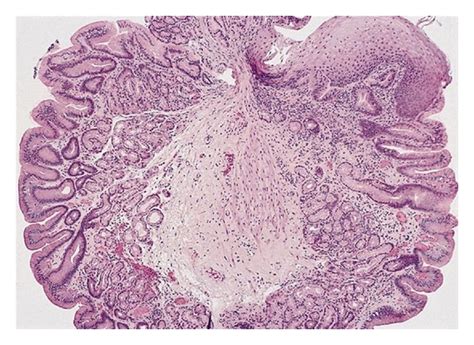 Normal Gastric Mucosa Histology