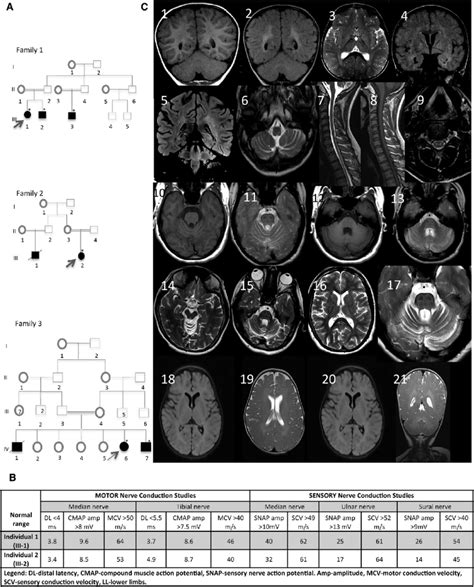 Identification Of Three Families Affected By Progressive Spastic Ataxia