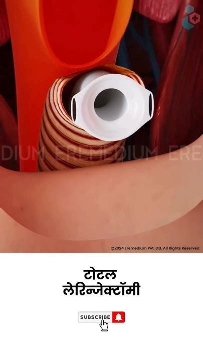 लेरिन्जेक्टॉमी गले के कैंसर की सर्जरी ↪ 3d Medical Animation Shorts