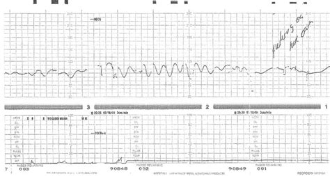 Fetal Heart Rate Fhr Tracing Recorded In A Fetus At 32 Weeks Download Scientific Diagram