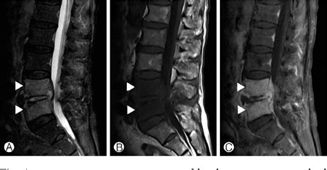 Osteomyelitis X Ray Spine