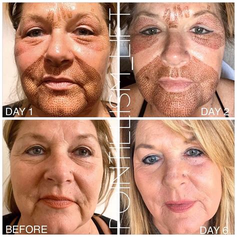 Finest Full Face Fibroblast Before And After In The Year 2023 Learn