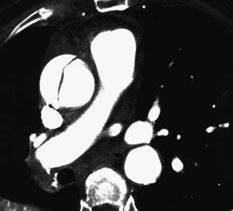 Ct Pulmonary Angiography A Comparative Analysis Of The Utilization