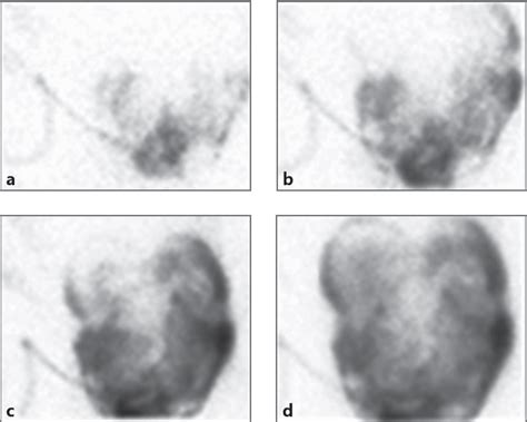 Figure 1 From Imaging Of The Peritoneum Evaluated By 99mtc Icodextrin