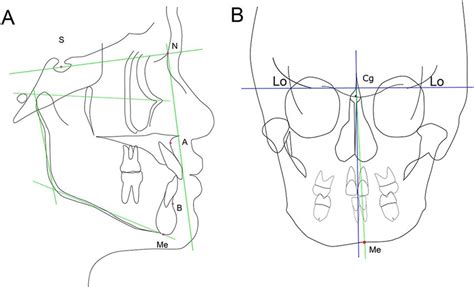 Cephalometric Reference Points And Lines A Lateral View S Sella