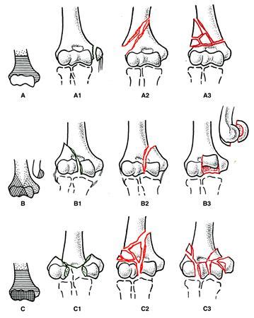 Distal Humerus Fracture Classification